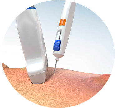 Vein Closure Device